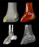 Ankle fracture