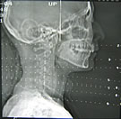 MED X-ray Head Side